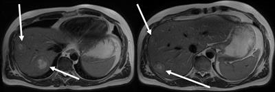 Liquid biopsy can cure early colorectal cancer recurrence – Case Report